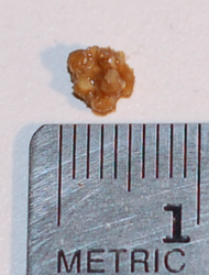 Kidney stone 5mm.png