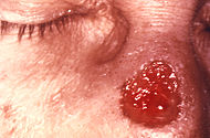 Gumma of nose due to a long standing tertiary syphilitic Treponema pallidum infection 5330 lores.jpg